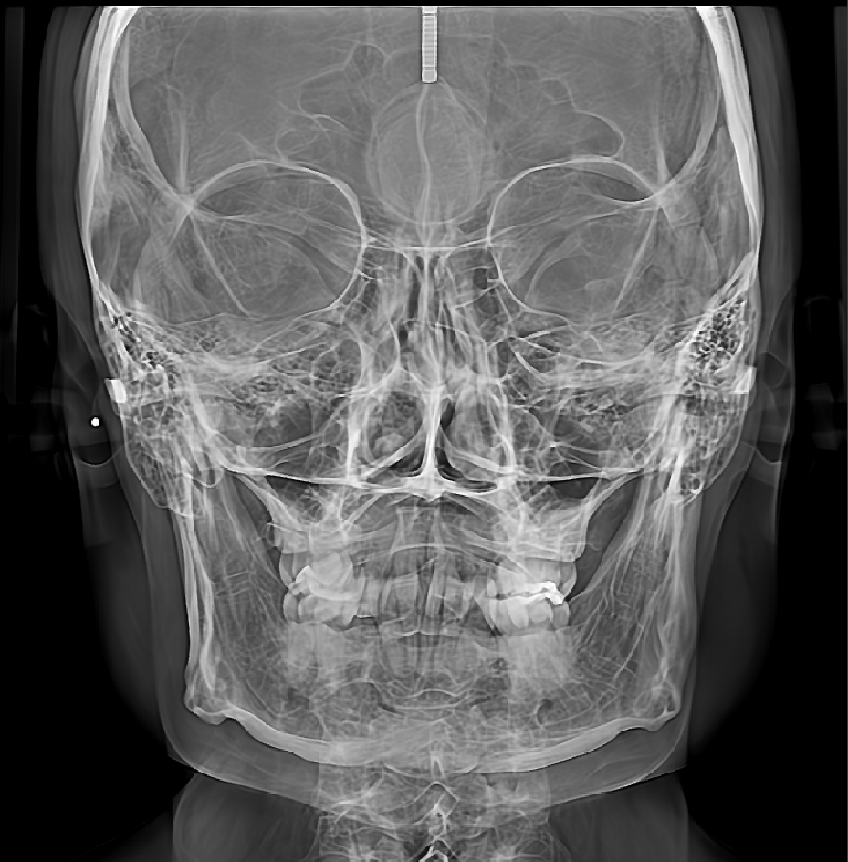 Proyección anteroposterior