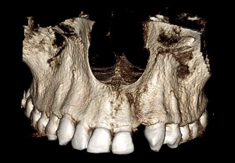 Reconstrucción 3D de maxilar