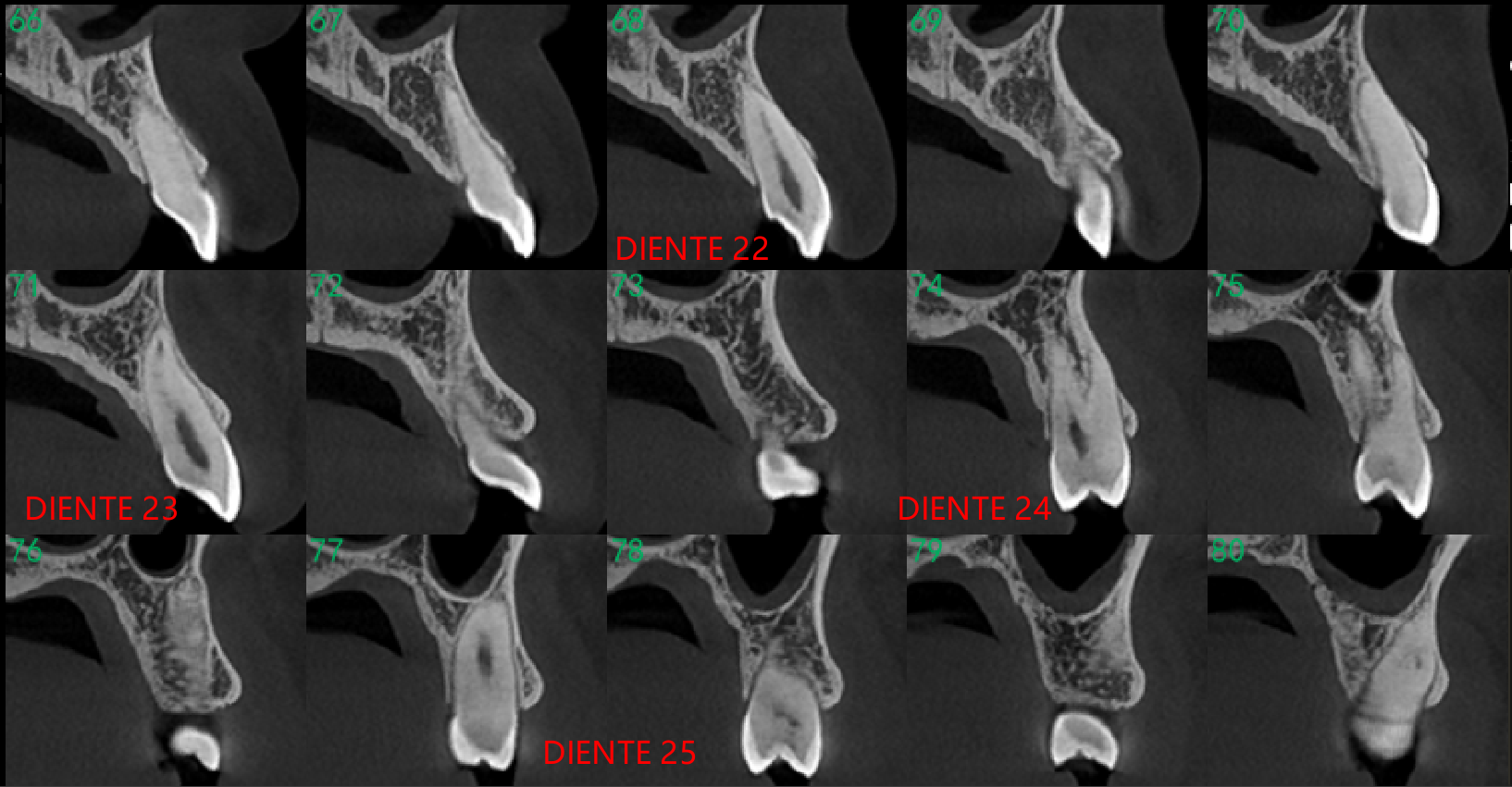 Tomografía dental